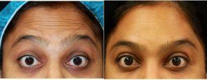 Dr. Shaun Patel, MD, Miami Physician - 38 Year Old Female Treated With Botox For Forehead Wrinkles