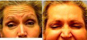 Dr. Stephanie Beidler Teotia, MD, Dallas Plastic Surgeon - 72 Year Old Woman Treated With Botox
