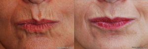 Dr. Stephen Weber, MD, FACS, Denver Facial Plastic Surgeon - Botox For Drooping Mouth Corners