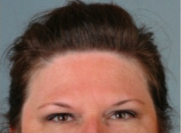 Dr. Suzanne Yee, MD, Little Rock Facial Plastic Surgeon - 50 Year Old Woman Treated With Botox