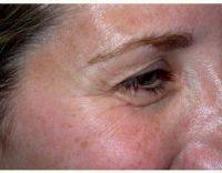 Dr. T.G. Khan, DO, FACS, Fort Lee Oculoplastic Surgeon - 42 Year Old Woman Treated With Botox