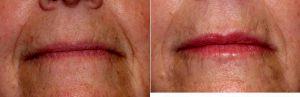 Dr. Theda C. Kontis, MD, Baltimore Facial Plastic Surgeon - Restylane Injection To Nasolabial Folds