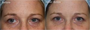 Dr. Tri Nguyen, Dermatologist In Houston, TX - Botox For Frown Lines