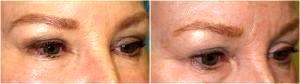 Dr. Tri Nguyen, Dermatologist In Houston, TX - Botox Injections Before And After (1)