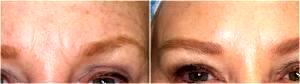 Dr. Tri Nguyen, Dermatologist In Houston, TX - Botox Injections Before And After (2)