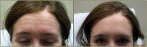Dr. Tricia Brown, Dermatologist In Houston, TX - Before And After Botox Forehead