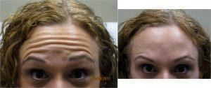 Dr. Tricia Brown, Dermatologist In Houston, TX - Botox Forehead Lines