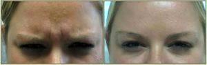 Dr. Tricia Brown, Dermatologist In Houston, TX - Frown Lines