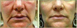 Dr. Tricia Brown, Dermatologist In Houston, TX - Perlane For Lips Before And After (1)