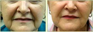 Dr. Tricia Brown, Dermatologist In Houston, TX - Perlane For Lips Before And After (2)
