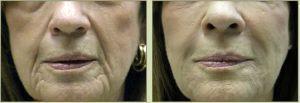 Dr. Tricia Brown, Dermatologist In Houston, TX - Perlane For Lips Before And After (3)