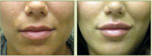 Dr. Tricia Brown, Dermatologist In Houston, TX - Perlane For Lips Before And After (4)