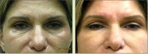 Dr. Tricia Brown, Dermatologist In Houston, TX - Restylane Filler Before And After (1)