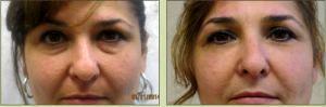 Dr. Tricia Brown, Dermatologist In Houston, TX - Restylane Filler Before And After (2)