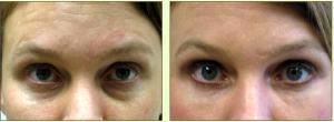 Dr. Tricia Brown, Dermatologist In Houston, TX - Restylane Filler Before And After (3)
