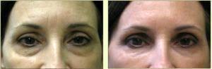 Dr. Tricia Brown, Dermatologist In Houston, TX - Restylane Filler Before And After (4)
