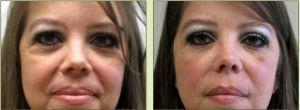 Dr. Tricia Brown, Dermatologist In Houston, TX - Restylane Filler Before And After (5)