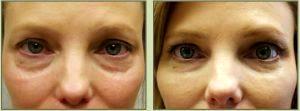 Dr. Tricia Brown, Dermatologist In Houston, TX - Restylane Filler Before And After (6)