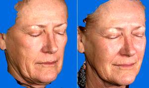 Dr. Victor Lacombe, MD, Santa Rosa Facial Plastic Surgeon - Juvederm Voluma