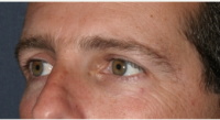 Dr. William Groff, DO, San Diego Dermatologist - 41 Year Old Man Treated With Botox