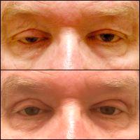 Droopy Eyes After Botox