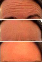 Dynamic Wrinkles Tend To Respond Best To Botox