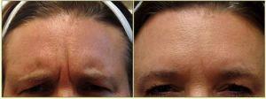 Dysport 11 Lines Before And After By Dr. Tricia Brown, Dermatologist In Houston, TX