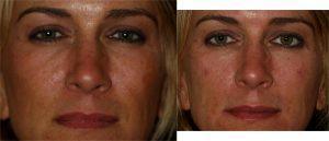 Dysport And Restylane to Tear Troughs by Dr. Otto J. Placik, Chicago Plastic Surgeon (1)