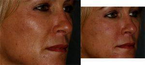 Dysport And Restylane to Tear Troughs by Dr. Otto J. Placik, Chicago Plastic Surgeon (2)
