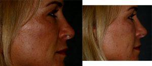 Dysport And Restylane to Tear Troughs by Dr. Otto J. Placik, Chicago Plastic Surgeon (3)