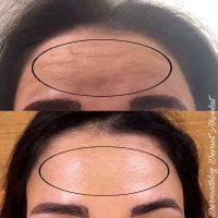 Dysport For Forehead Lines Before And After