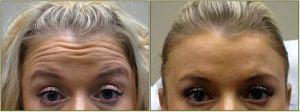 Dysport For Forehead Lines By Dr. Tricia Brown, Dermatologist In Houston, TX
