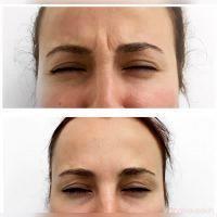 Dysport For Frown Lines Before And After Pic
