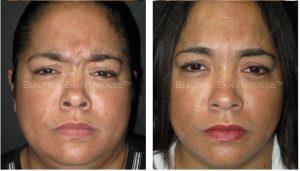 Dysport Injections To The Forehead, Crows Feet, And Glabella By Paul M. Friedman, MD, Dermatologist In Houston, Texas (1)