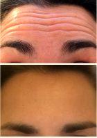 Dysport Or Botox For Deep Forehead Crease