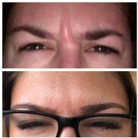 Effectively Get Rid Of Brow Furrow