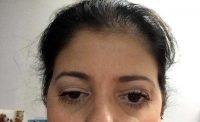 Eyebrow Droop From Botox