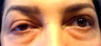 Eyelid Drooping After Botox