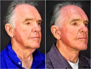 Facelift And Hyaluronic Filler In The Cheeks By Dr. Goesel Anson, Dr. Michael Edwards, Dr. Terrence Higgins, Plastic Surgeons In The Clark County, Nevada (1)