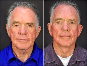 Facelift And Hyaluronic Filler In The Cheeks By Dr. Goesel Anson, Dr. Michael Edwards, Dr. Terrence Higgins, Plastic Surgeons In The Clark County, Nevada (2)
