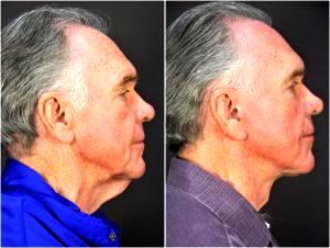 Facelift And Hyaluronic Filler In The Cheeks By Dr. Goesel Anson, Dr. Michael Edwards, Dr. Terrence Higgins, Plastic Surgeons In The Clark County, Nevada (3)