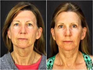 Facelift, Fat Injection, Injectable Fillers And Botox By Goesel Anson, MD, FACS, Plastic Surgeon In The Clark County, Nevada (1)