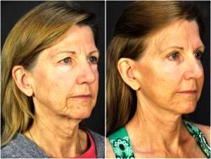 Facelift, Fat Injection, Injectable Fillers And Botox By Goesel Anson, MD, FACS, Plastic Surgeon In The Clark County, Nevada (2)