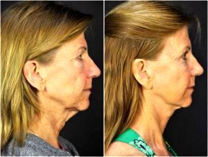 Facelift, Fat Injection, Injectable Fillers And Botox By Goesel Anson, MD, FACS, Plastic Surgeon In The Clark County, Nevada (3)