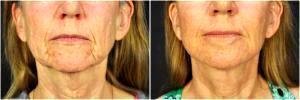 Facelift, Fat Injection, Injectable Fillers And Botox By Goesel Anson, MD, FACS, Plastic Surgeon In The Clark County, Nevada (4)
