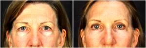 Facelift, Fat Injection, Injectable Fillers And Botox By Goesel Anson, MD, FACS, Plastic Surgeon In The Clark County, Nevada (5)