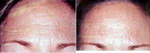 Female Botox Before And After By Dr George Lefkovits, MD, New York Plastic Surgeon 679