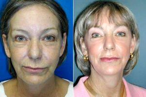 Filler, Botox, And Laser Resurfacing By Doctor Hannah Vargas, MD, Kansas City Facial Plastic Surgeon