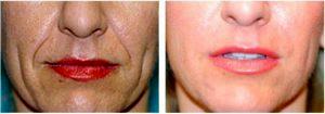 Filler By David A. Hecht, MD, PC, Plastic Surgeon In Scottsdale, Arizona (2)