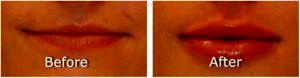 Filler For Lips By Dr. S. Kent Brown, MD, Scottsdale AZ Physician (1)